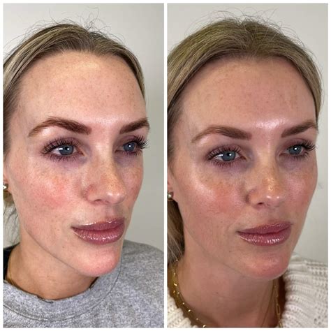 3 syringes 2. . Pcl skin booster before and after
